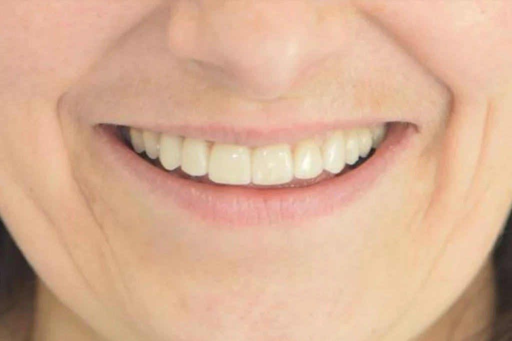facettes dentaires paris Dentisterie esthétique à Paris 17 | Dr Youri Emsallem Dentisterie esthétique