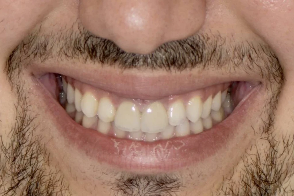 facettes dentaires paris Dentisterie esthétique à Paris 17 | Dr Youri Emsallem Dentisterie esthétique