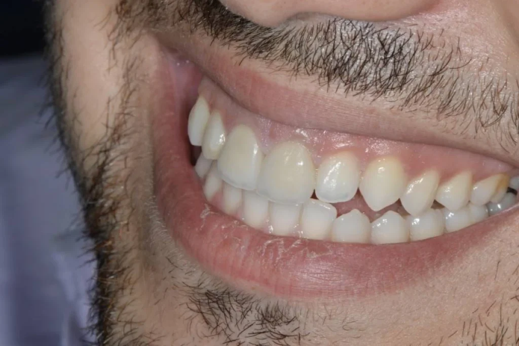 facettes dentaires paris Dentisterie esthétique à Paris 17 | Dr Youri Emsallem Dentisterie esthétique
