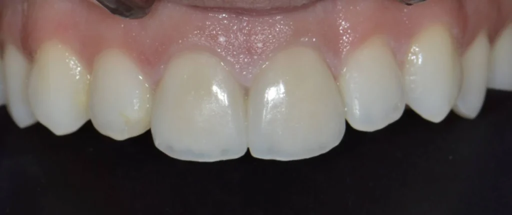 facettes dentaires paris Dentisterie esthétique à Paris 17 | Dr Youri Emsallem Dentisterie esthétique
