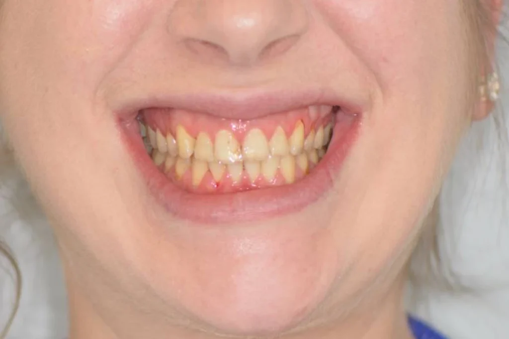 facettes dentaires paris Dentisterie esthétique à Paris 17 | Dr Youri Emsallem Dentisterie esthétique