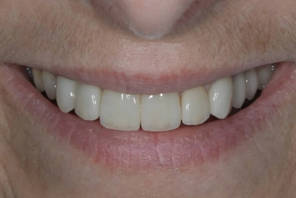 facettes dentaires paris Dentisterie esthétique à Paris 17 | Dr Youri Emsallem Dentisterie esthétique
