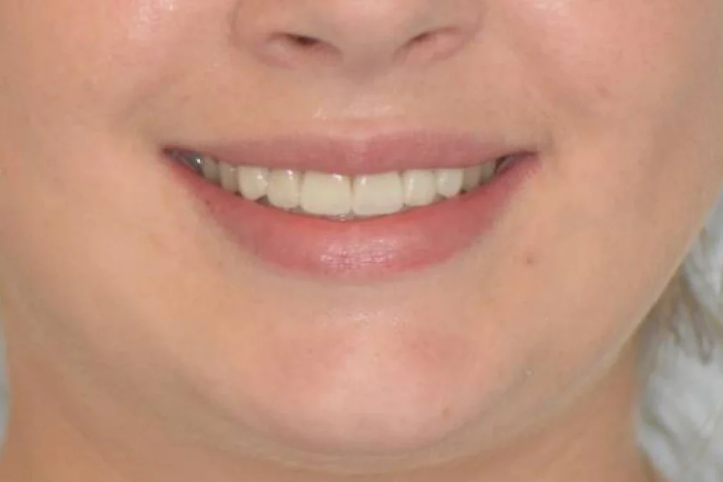 facettes dentaires paris Dentisterie esthétique à Paris 17 | Dr Youri Emsallem Dentisterie esthétique