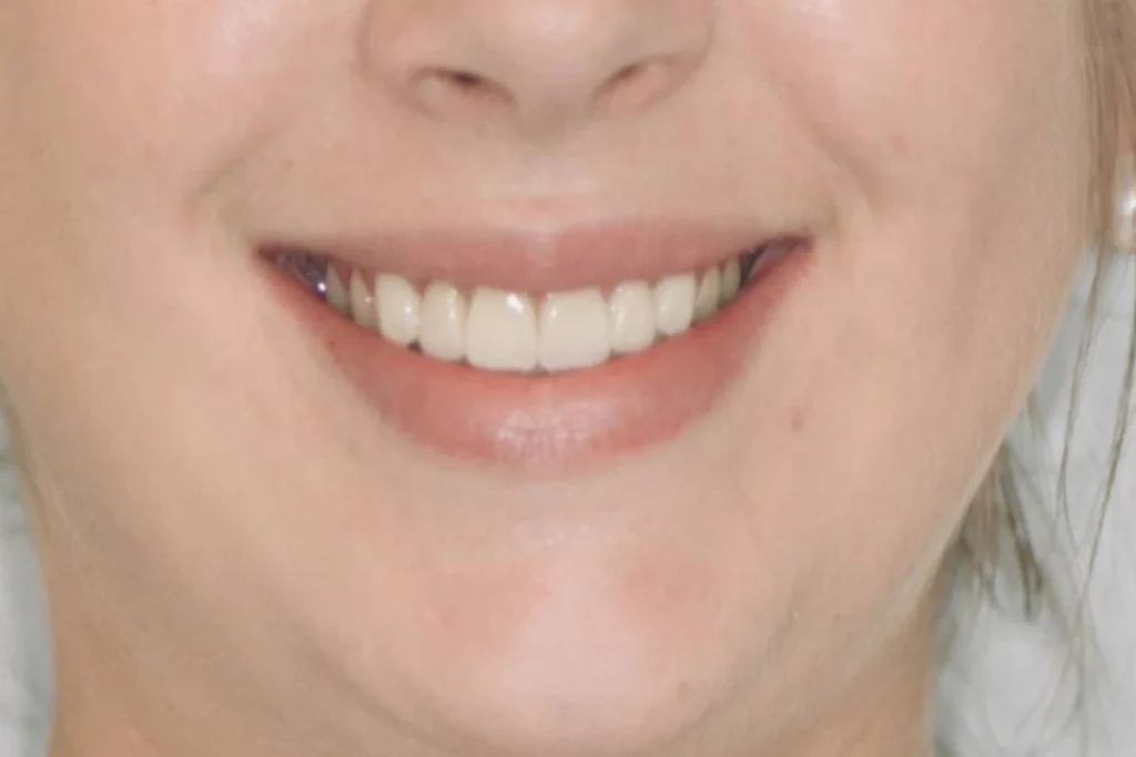 facettes dentaires paris Dentisterie esthétique à Paris 17 | Dr Youri Emsallem Dentisterie esthétique