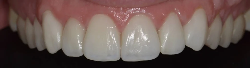 facettes dentaires paris x Dentisterie esthétique à Paris 17 | Dr Youri Emsallem Dentisterie esthétique