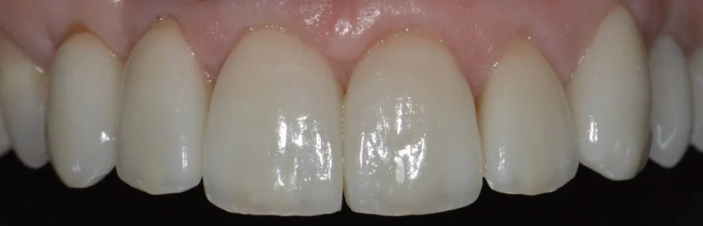 facettes dentaires paris Dentisterie esthétique à Paris 17 | Dr Youri Emsallem Dentisterie esthétique