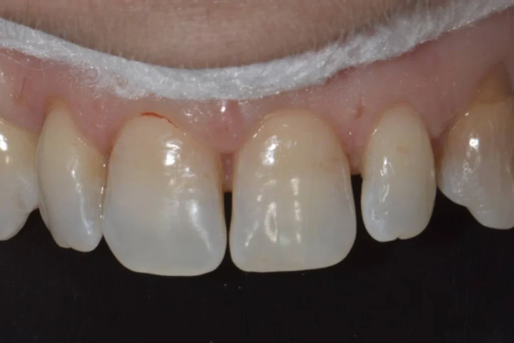 facettes dentaires paris Dentisterie esthétique à Paris 17 | Dr Youri Emsallem Dentisterie esthétique