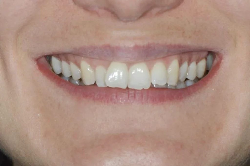 gouttieres transparentes paris Dentisterie esthétique à Paris 17 | Dr Youri Emsallem Dentisterie esthétique