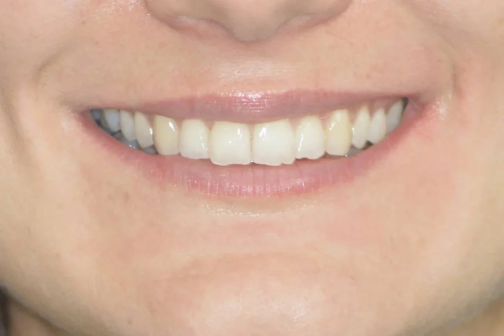 gouttieres transparentes paris Dentisterie esthétique à Paris 17 | Dr Youri Emsallem Dentisterie esthétique