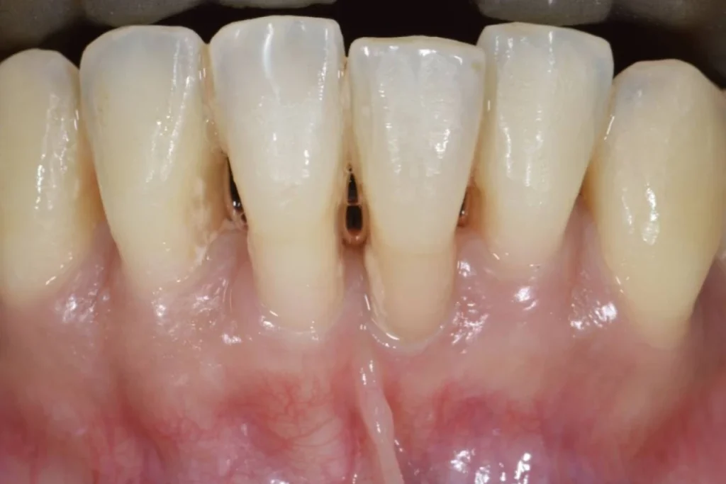 greffes gencive paris Soin de gencives | Greffe de gencive | Dentiste Paris 17 Soin de gencives Paris