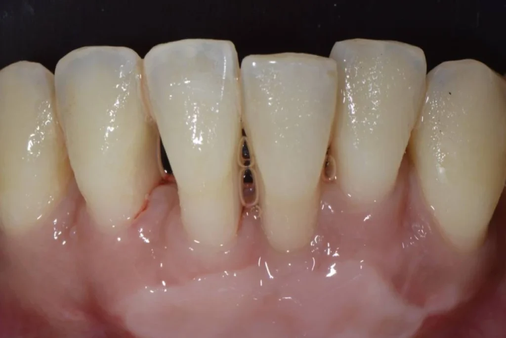 greffes gencive paris Soin de gencives | Greffe de gencive | Dentiste Paris 17 Soin de gencives Paris