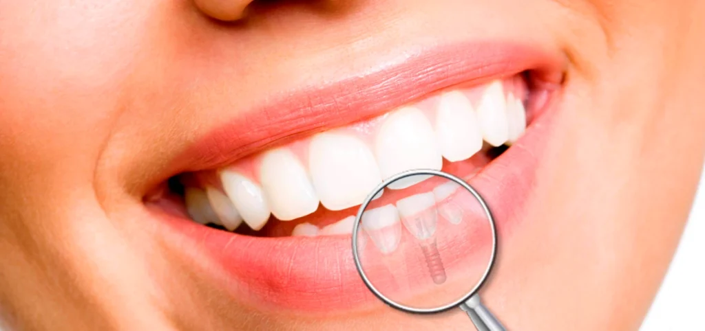 implant dentaire paris Pose d'un implant dentaire Chirurgien-dentiste - Dr Youri Emsallem à Paris 75017
