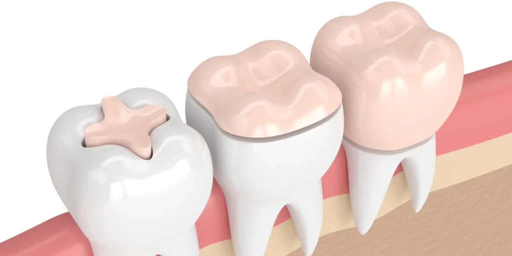 inlay onlay dentiste paris Soins conservateurs dentaires Paris 17 | Inlays/Onlays céramique Soins conservateurs Paris 17