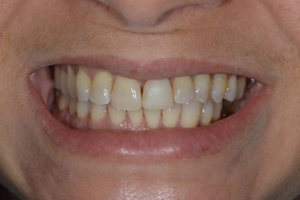 remplacement couronne paris Dentisterie esthétique à Paris 17 | Dr Youri Emsallem Dentisterie esthétique
