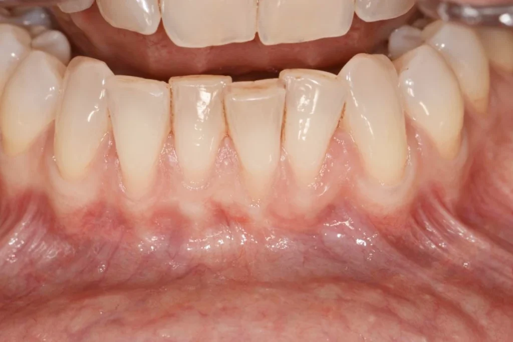 soin gencives paris Soin de gencives | Greffe de gencive | Dentiste Paris 17 Soin de gencives Paris