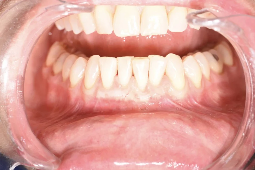 soin gencives paris Soin de gencives | Greffe de gencive | Dentiste Paris 17 Soin de gencives Paris