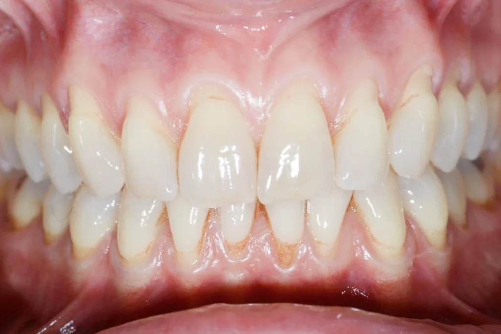 soin gencives paris Soin de gencives | Greffe de gencive | Dentiste Paris 17 Soin de gencives Paris