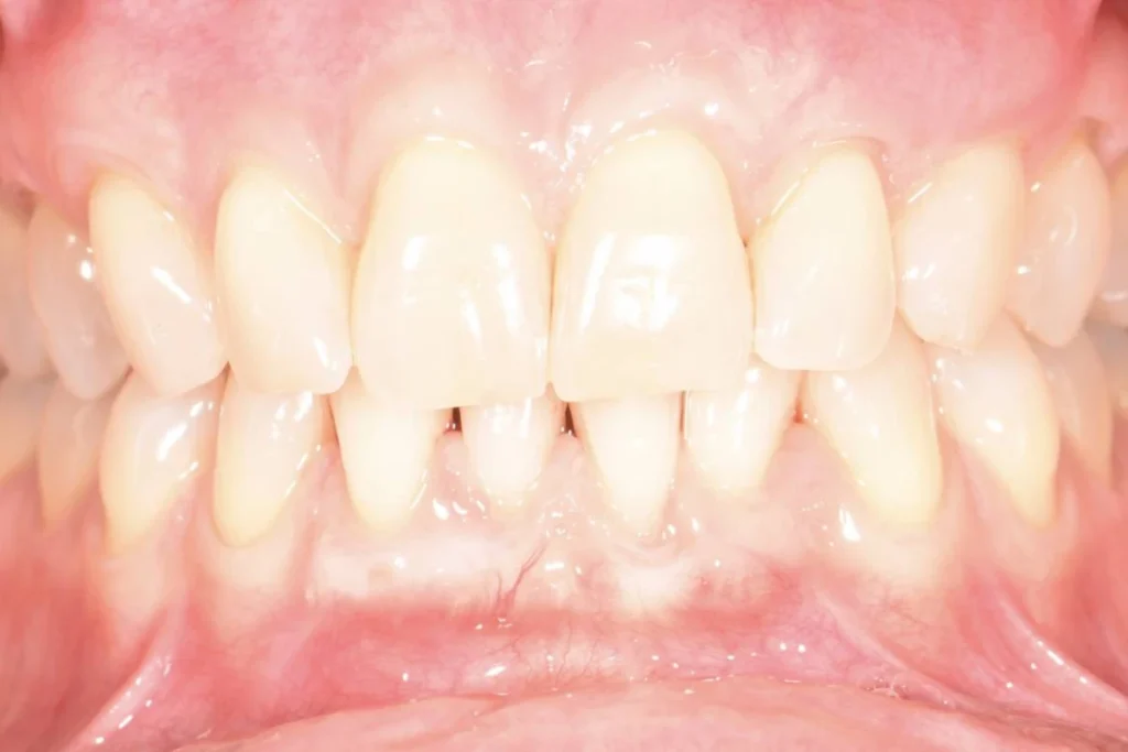soin gencives paris Soin de gencives | Greffe de gencive | Dentiste Paris 17 Soin de gencives Paris