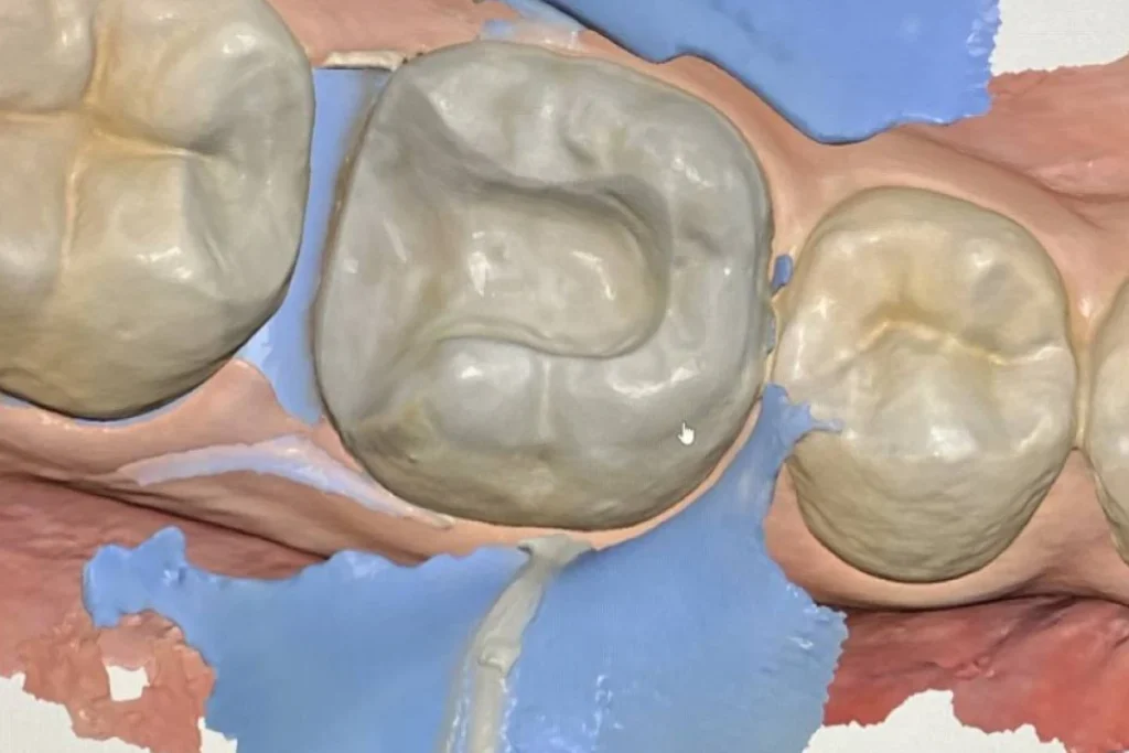 soins conservateurs dentiste paris Soins conservateurs dentaires Paris 17 | Inlays/Onlays céramique Soins conservateurs Paris 17