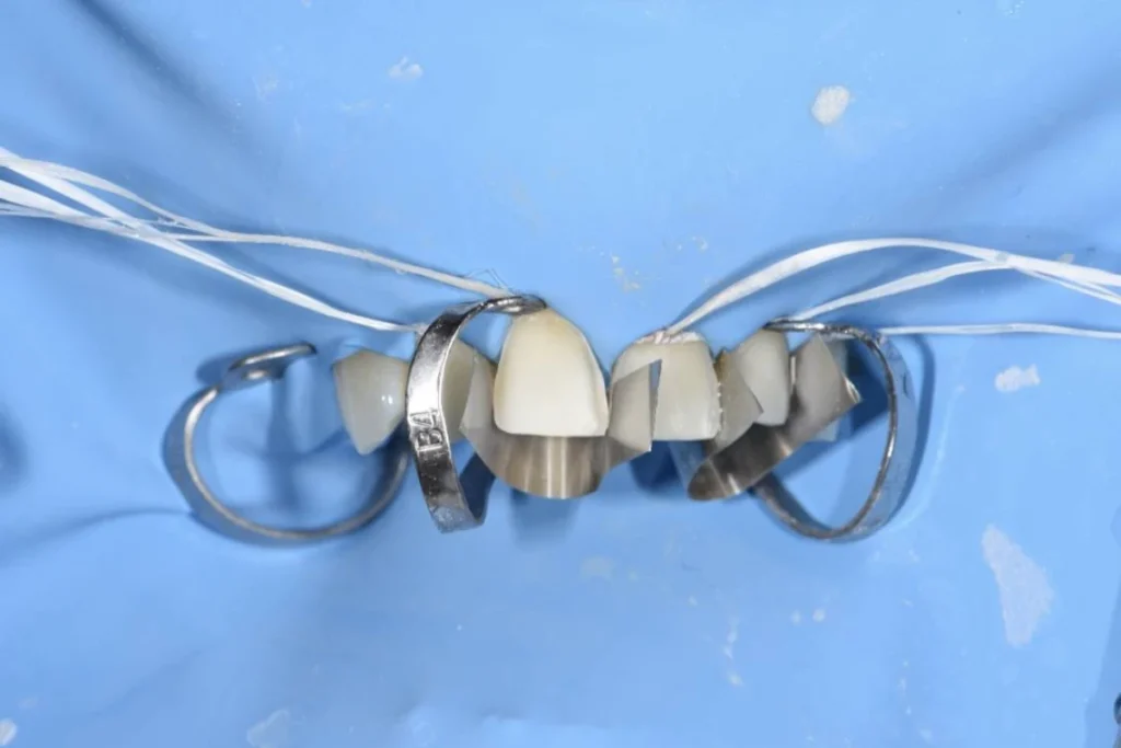 usure dentaire facettes ceramique paris usure dentaire facettes ceramique paris Prothèses dentaires Chirurgien-dentiste - Dr Youri Emsallem à Paris 75017