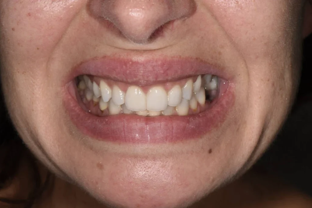 usure dentaire facettes ceramique paris usure dentaire facettes ceramique paris Prothèses dentaires Chirurgien-dentiste - Dr Youri Emsallem à Paris 75017